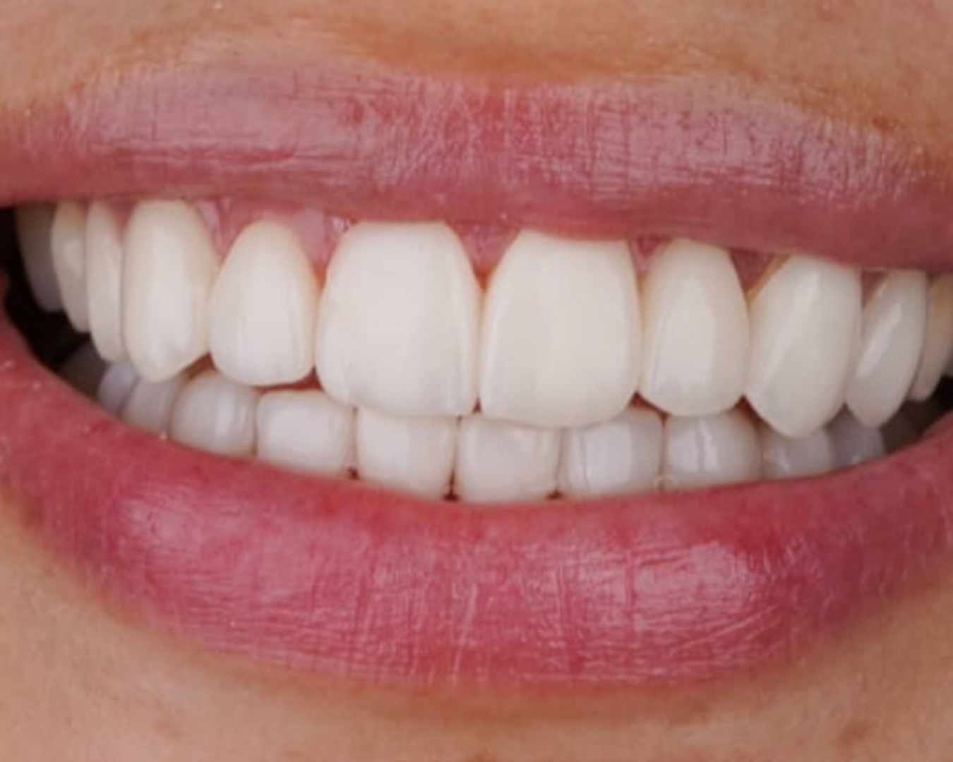 estetica-dental-carillas-naturales-2