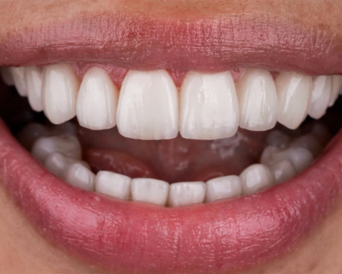 estetica-dental-carillas-naturales